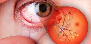 Degeneración macular, tercera causa de ceguera, afecta a 450 mil personas