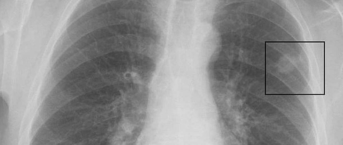 Descubren vía para frenar metástasis en cáncer de pulmón