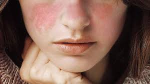 El lupus es una enfermedad difícil de detectar y tratar