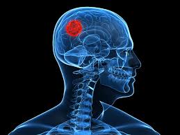 Tumores cerebrales más frecuentes en "inteligentes"