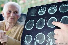 Buscan “firma molecular” del Alzheimer